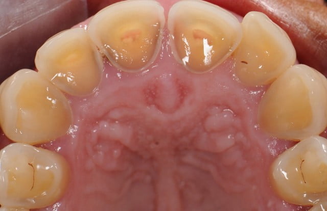 Resultado de imagen de perdida de esmalte dental